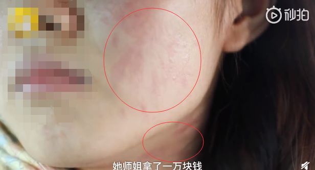 研究生幫師姐做實(shí)驗(yàn)?zāi)槻勘蛔苽?學(xué)校：系個人操作失誤 已支付90%住院費(fèi)